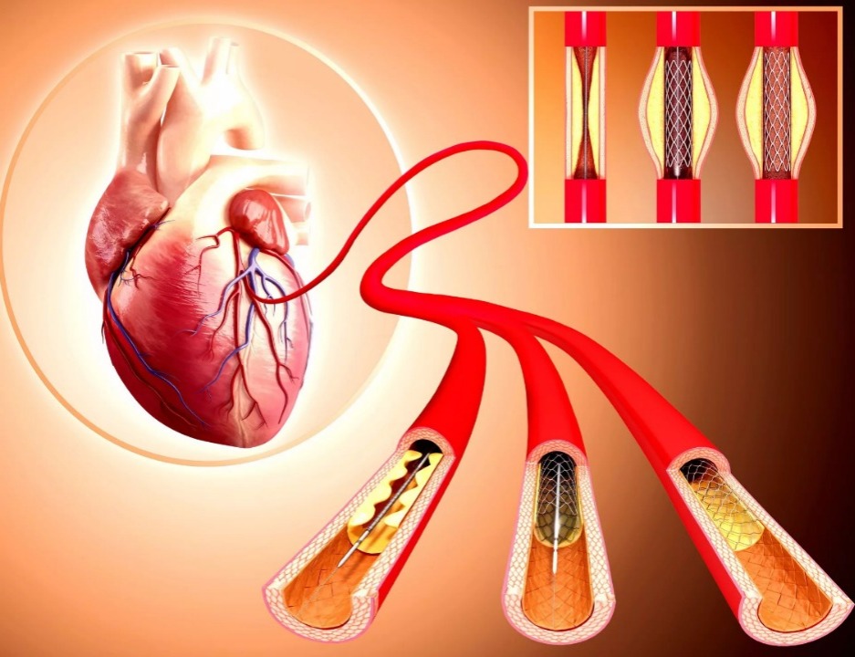 Anju nədir? Stent necə qoyulur? - MÜDDƏTİ