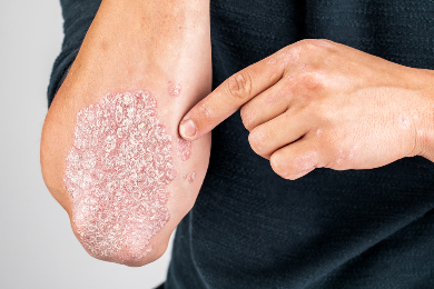 Psoriaz (pullu dəmrov) – bitkilərlə müalicəsi